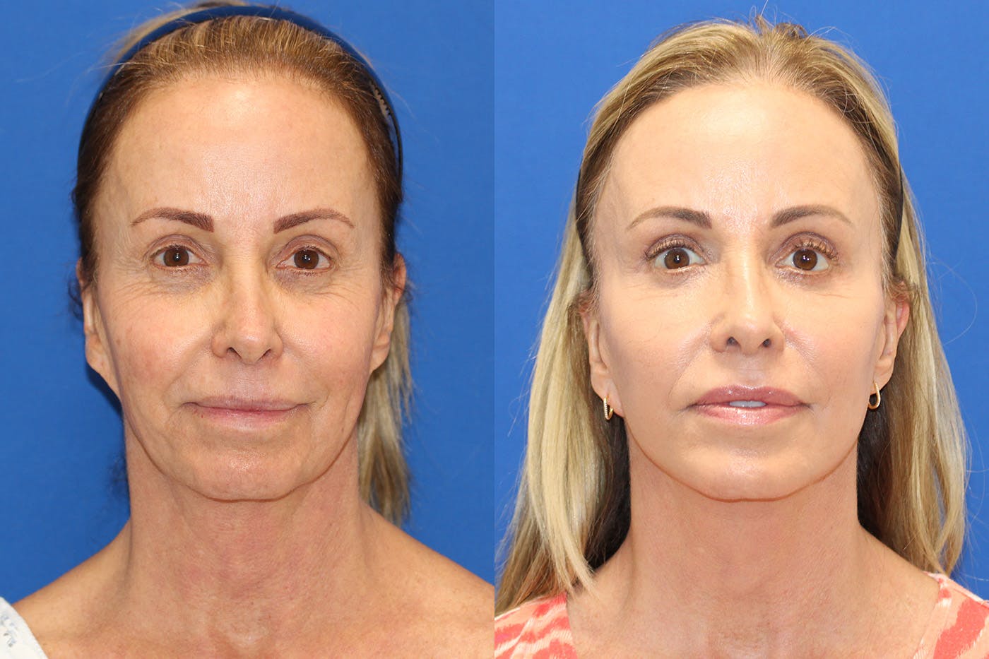 Vertical Restore® / Facial Rejuvenation Before & After Gallery - Patient 148561530 - Image 1