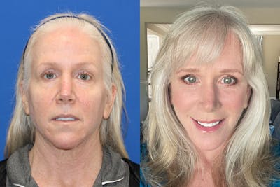 Vertical Restore® / Facial Rejuvenation Before & After Gallery - Patient 148561529 - Image 1