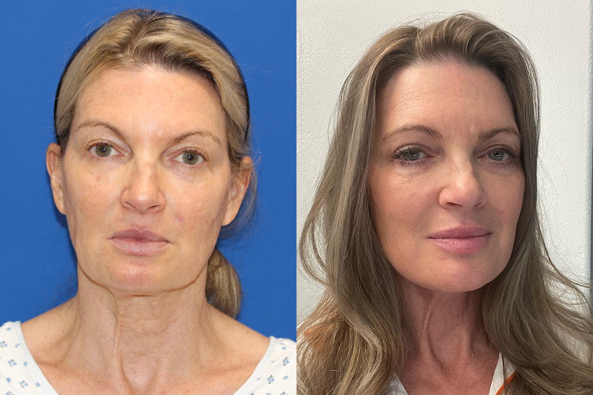 Vertical Restore® / Facial Rejuvenation Before & After Gallery - Patient 148561580 - Image 1