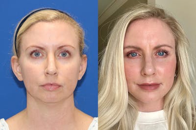 Vertical Restore® / Facial Rejuvenation Before & After Gallery - Patient 148561584 - Image 1