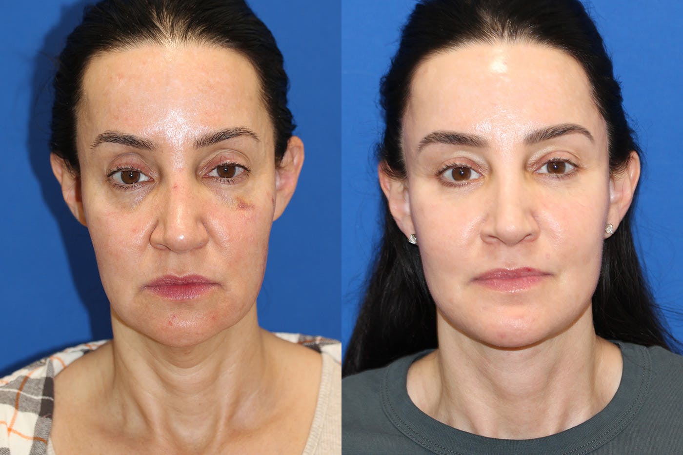 Vertical Restore® / Facial Rejuvenation Before & After Gallery - Patient 148561589 - Image 1