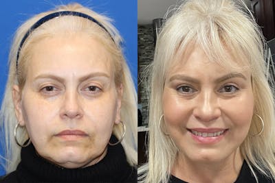 Vertical Restore® / Facial Rejuvenation Before & After Gallery - Patient 148561602 - Image 1