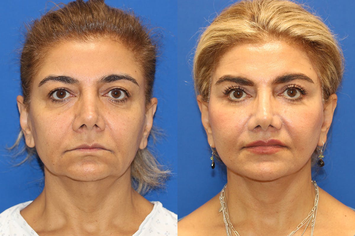 Vertical Restore® / Facial Rejuvenation Before & After Gallery - Patient 148561605 - Image 1