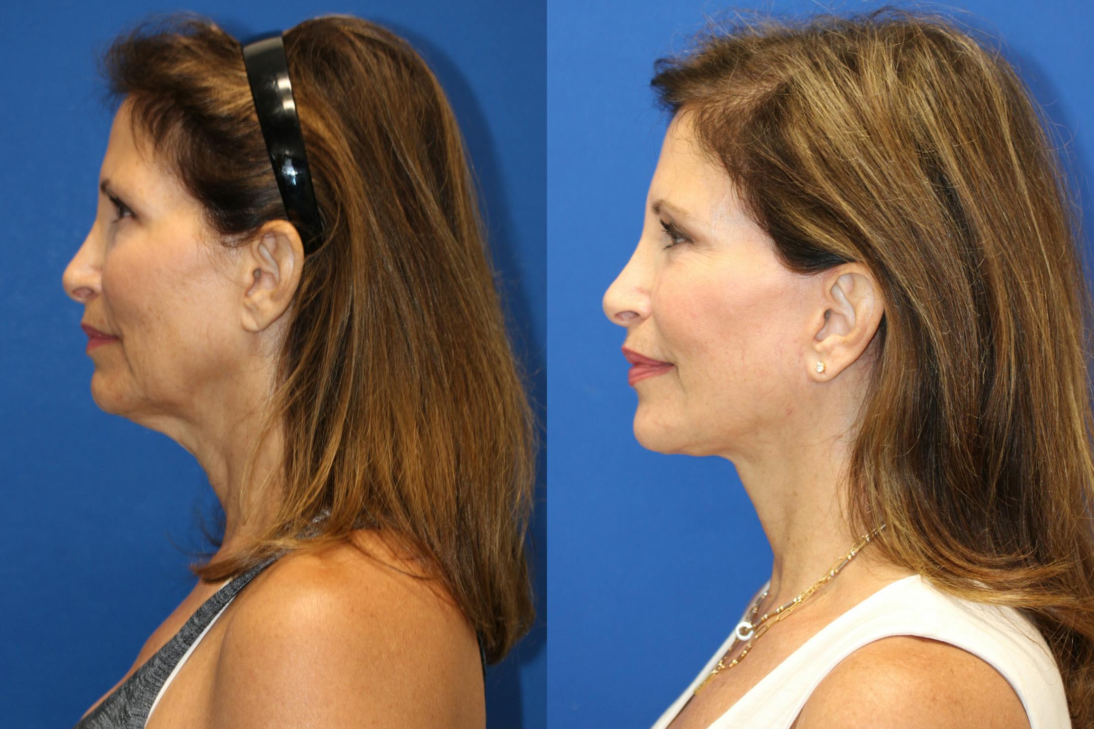 Vertical Restore® / Facial Rejuvenation Before & After Gallery - Patient 153265681 - Image 5
