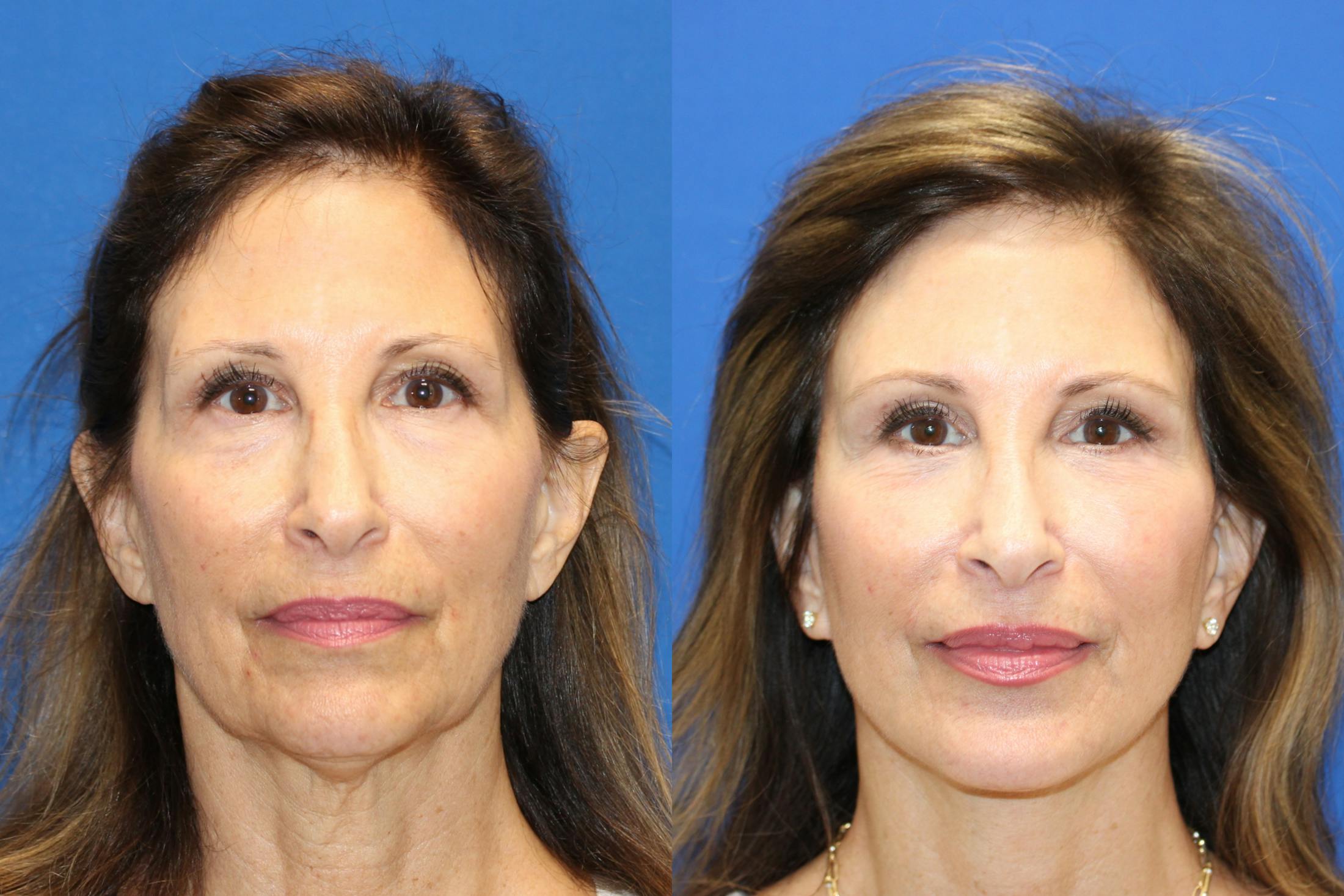 Vertical Restore® / Facial Rejuvenation Before & After Gallery - Patient 153265681 - Image 1