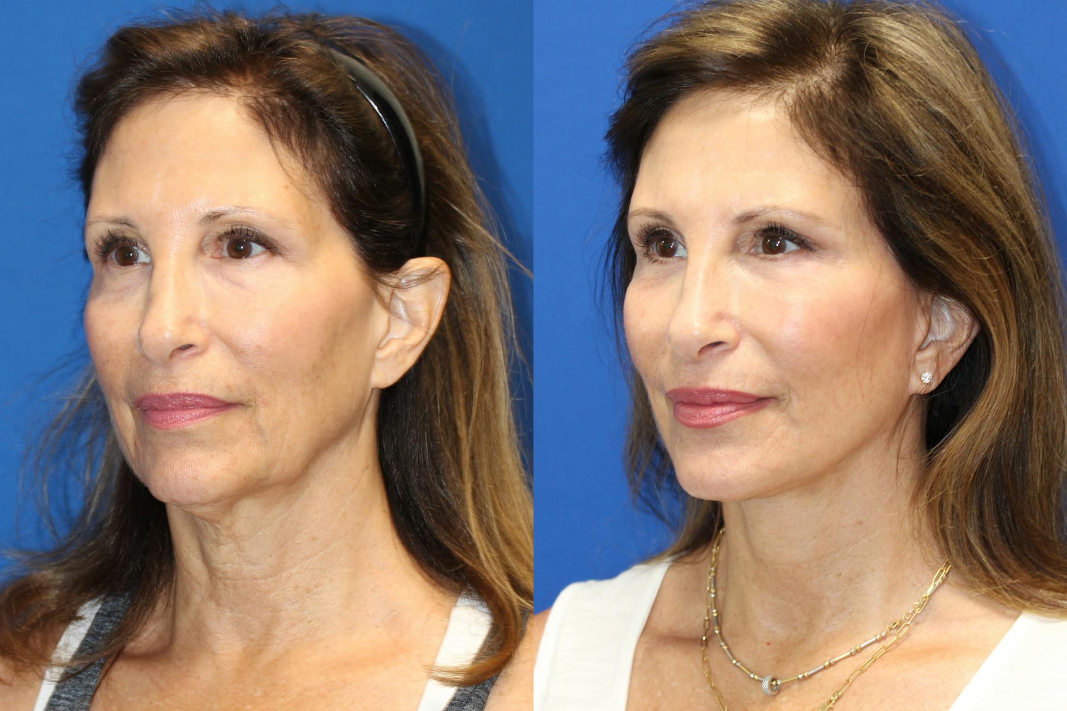 Vertical Restore® / Facial Rejuvenation Before & After Gallery - Patient 153265681 - Image 2