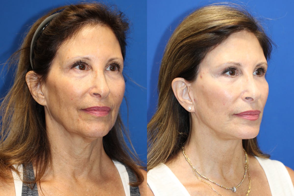 Vertical Restore® / Facial Rejuvenation Before & After Gallery - Patient 153265681 - Image 3
