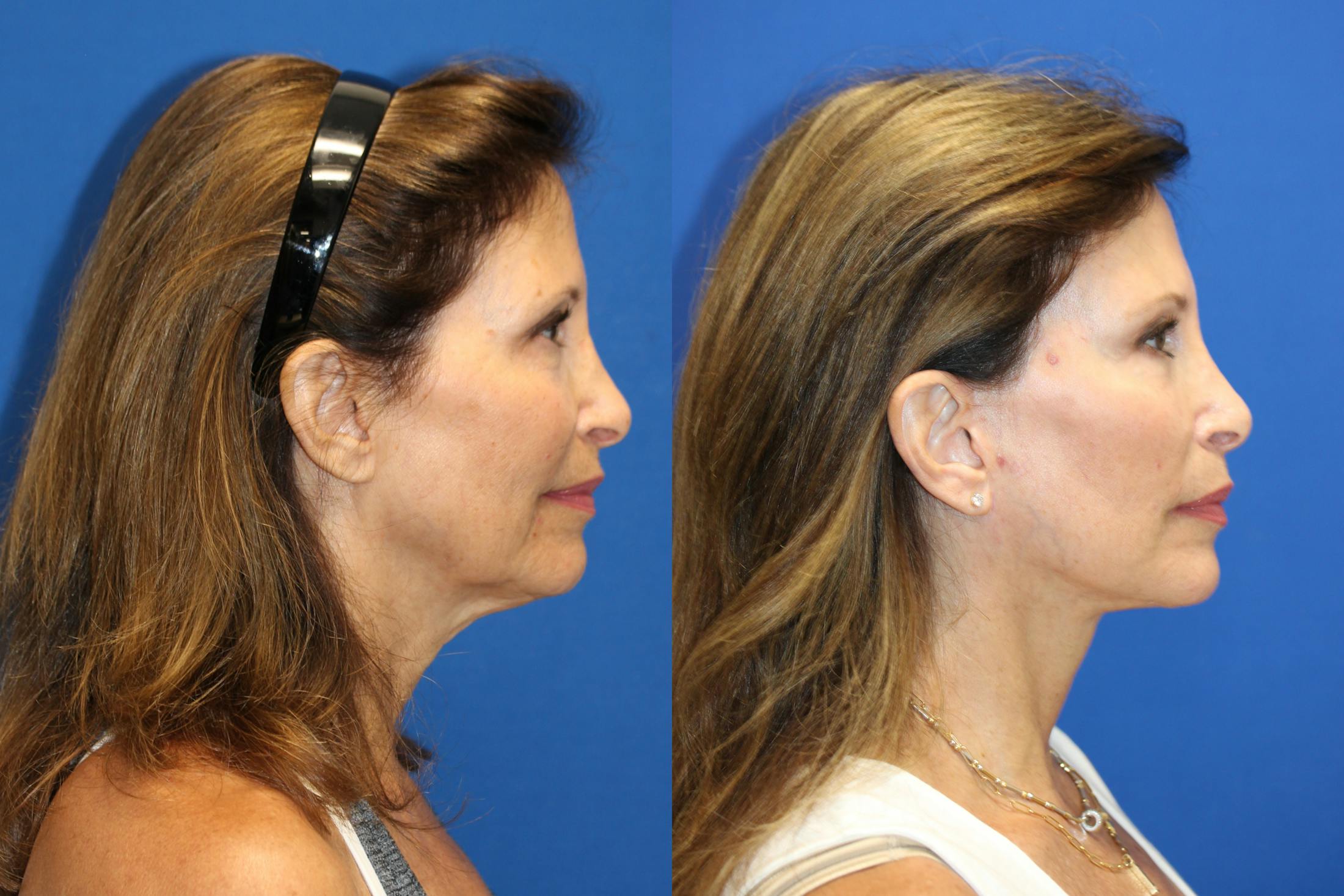 Vertical Restore® / Facial Rejuvenation Before & After Gallery - Patient 153265681 - Image 4