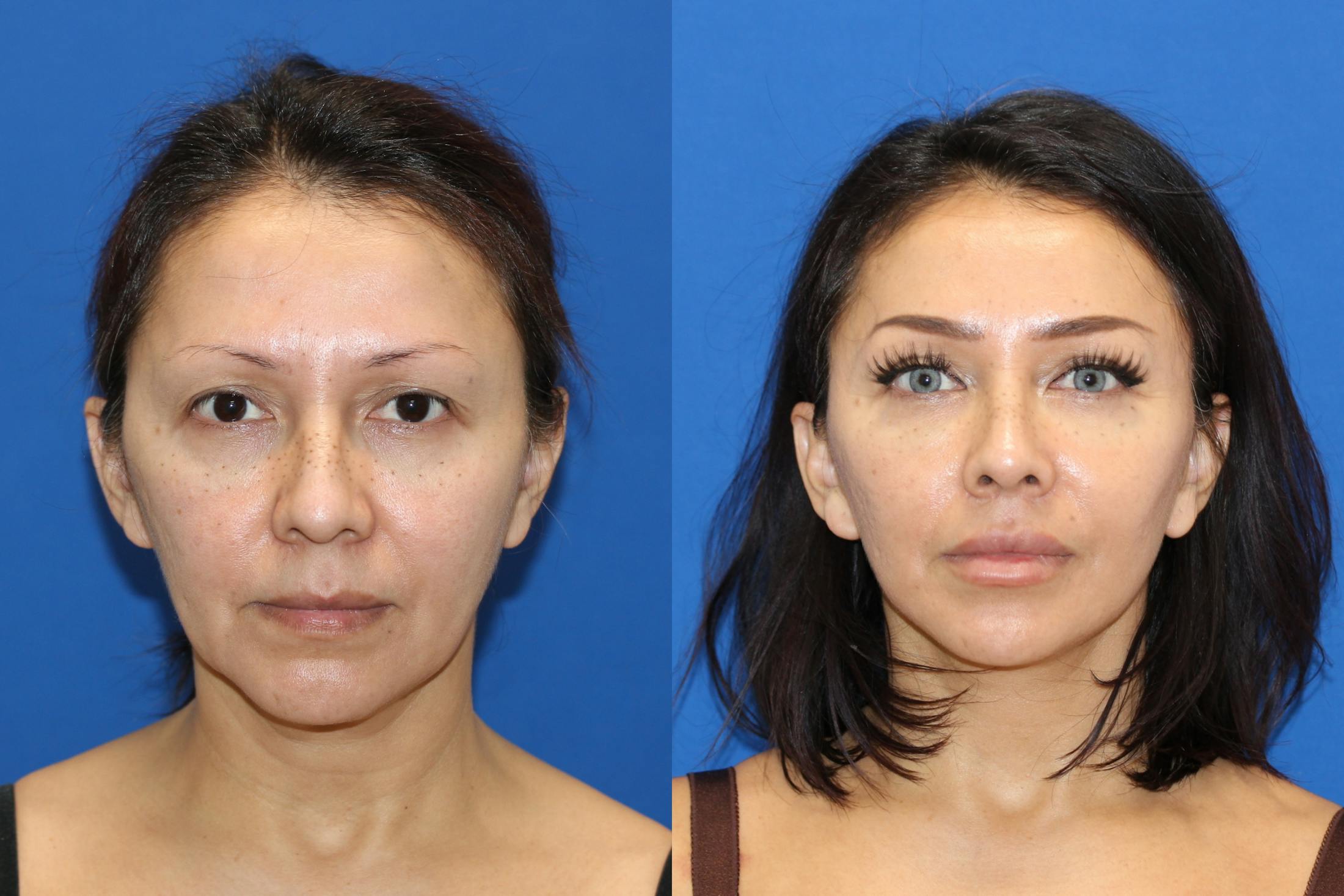 Vertical Restore® / Facial Rejuvenation Before & After Gallery - Patient 153265680 - Image 1