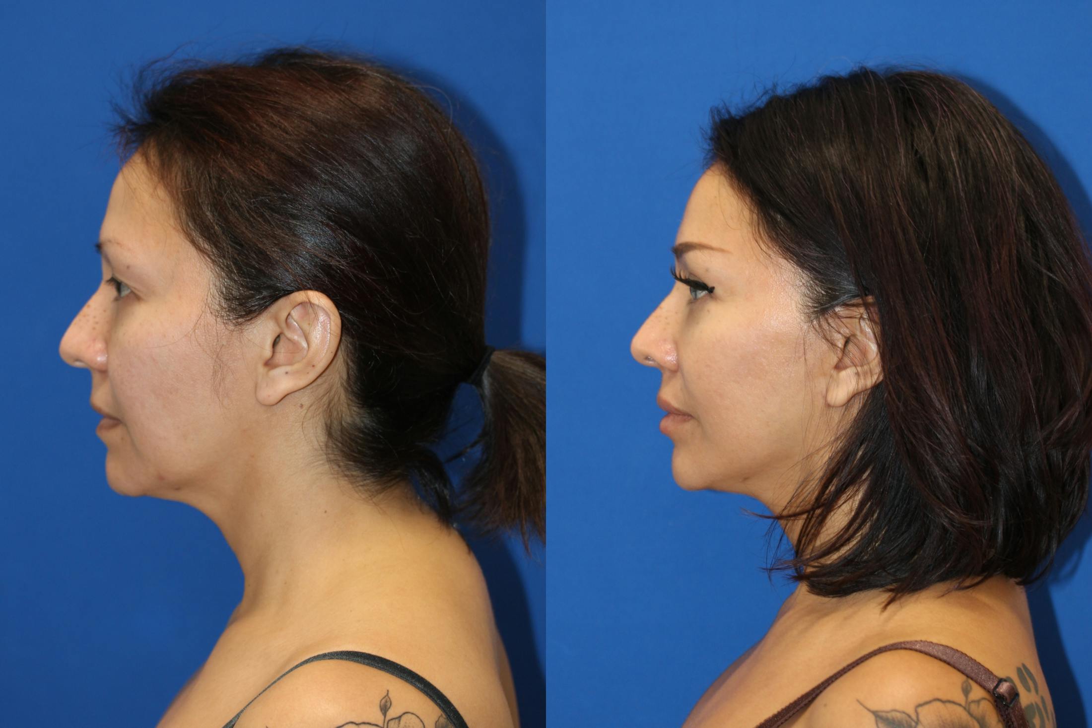 Vertical Restore® / Facial Rejuvenation Before & After Gallery - Patient 153265680 - Image 2