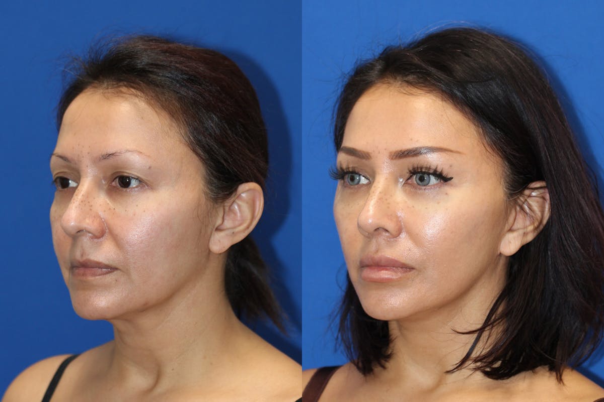 Vertical Restore® / Facial Rejuvenation Before & After Gallery - Patient 153265680 - Image 3