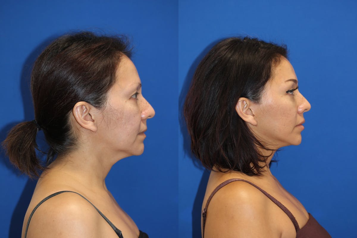 Vertical Restore® / Facial Rejuvenation Before & After Gallery - Patient 153265680 - Image 4