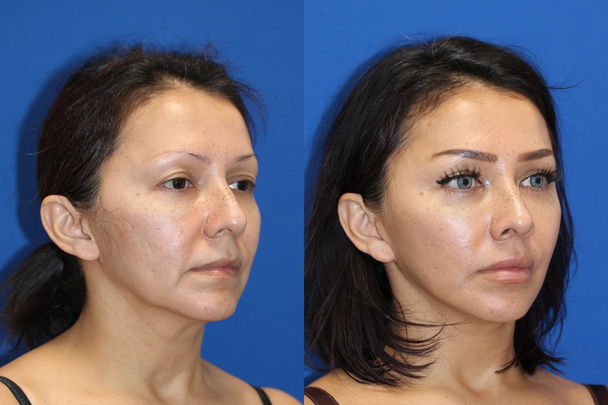 Vertical Restore® / Facial Rejuvenation Before & After Gallery - Patient 153265680 - Image 5