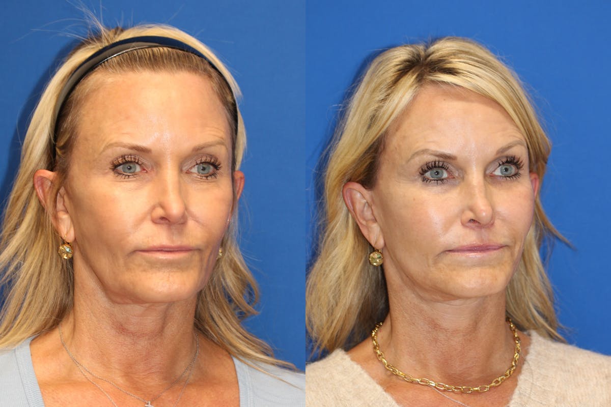 Vertical Restore® / Facial Rejuvenation Before & After Gallery - Patient 153265683 - Image 2