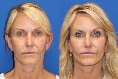 Vertical Restore® / Facial Rejuvenation Before & After Gallery - Patient 153265683 - Image 1