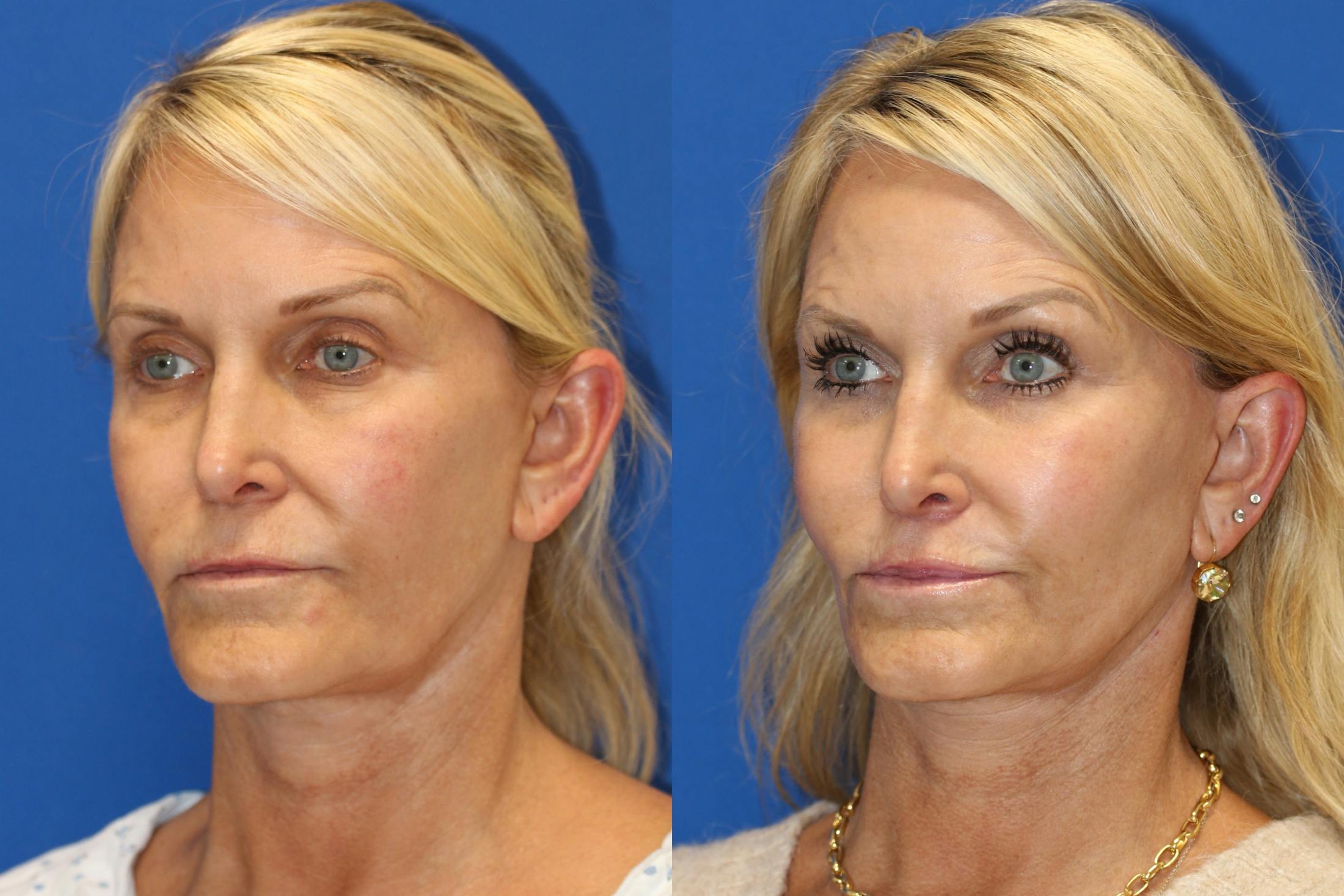 Vertical Restore® / Facial Rejuvenation Before & After Gallery - Patient 153265683 - Image 3