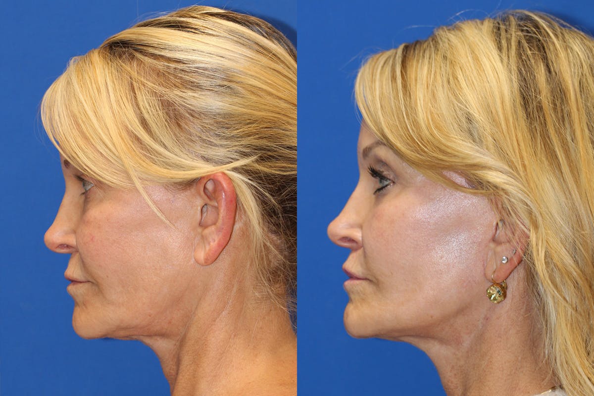 Vertical Restore® / Facial Rejuvenation Before & After Gallery - Patient 153265683 - Image 4