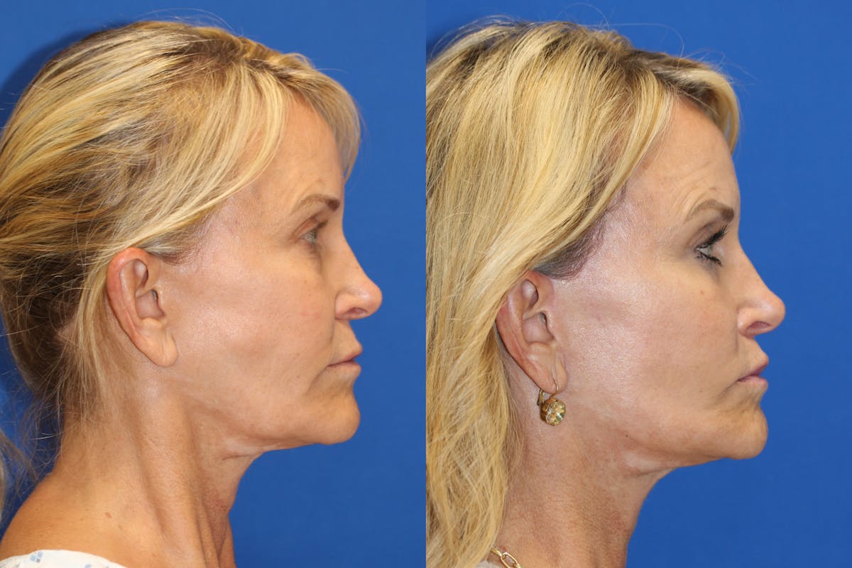 Vertical Restore® / Facial Rejuvenation Before & After Gallery - Patient 153265683 - Image 5