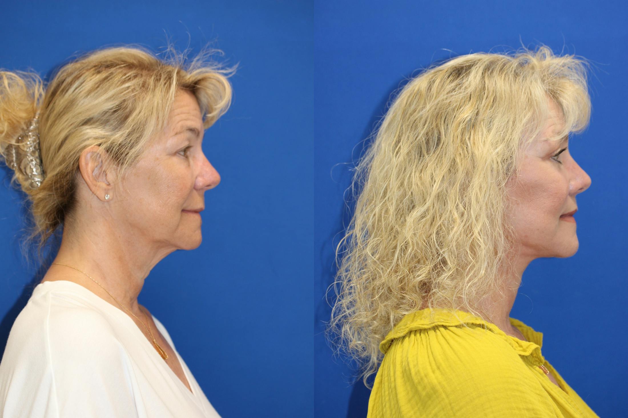 Vertical Restore® / Facial Rejuvenation Before & After Gallery - Patient 153265711 - Image 3