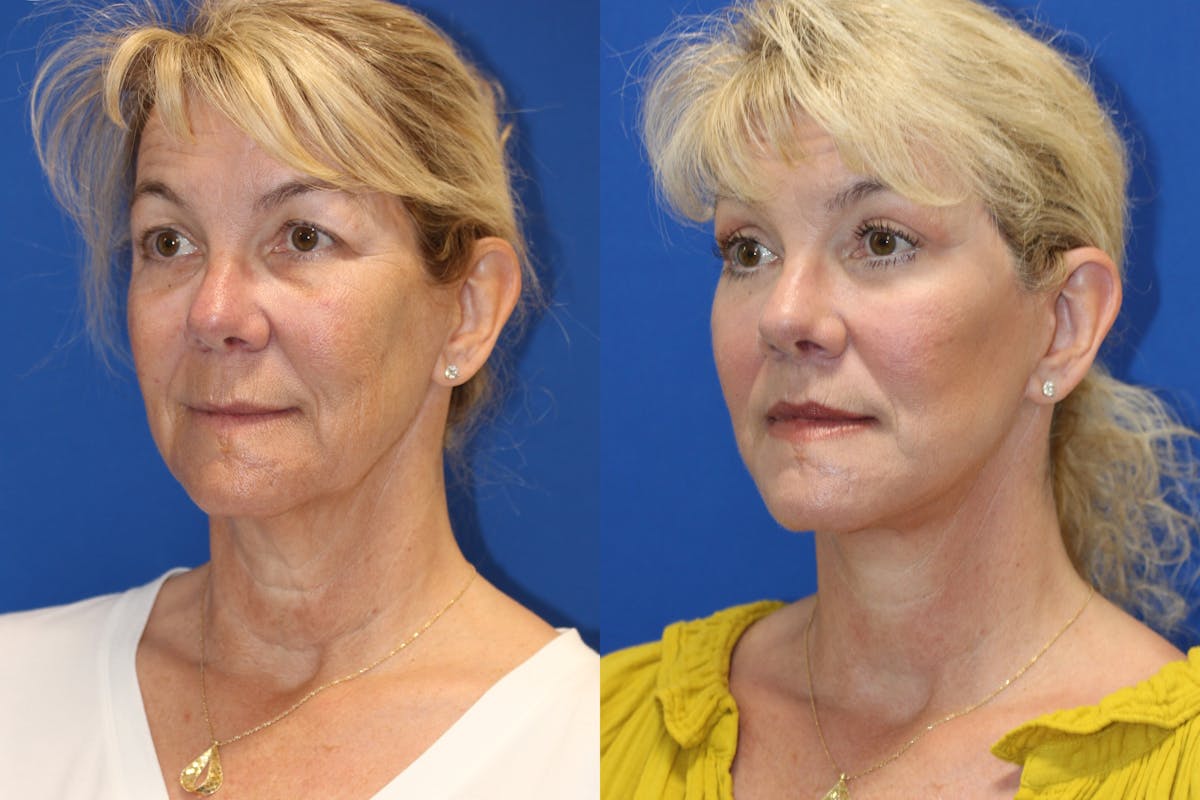 Vertical Restore® / Facial Rejuvenation Before & After Gallery - Patient 153265711 - Image 2