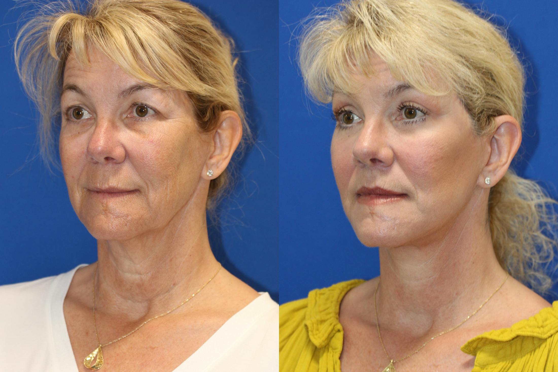 Vertical Restore® / Facial Rejuvenation Before & After Gallery - Patient 153265711 - Image 2