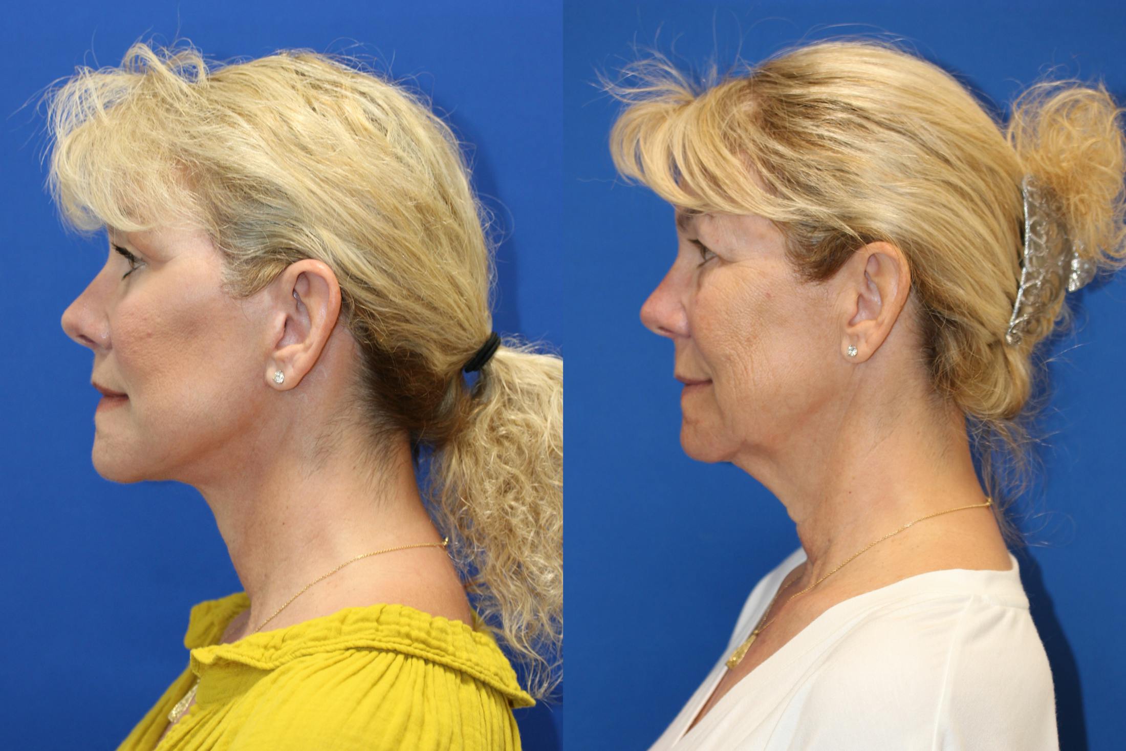 Vertical Restore® / Facial Rejuvenation Before & After Gallery - Patient 153265711 - Image 4