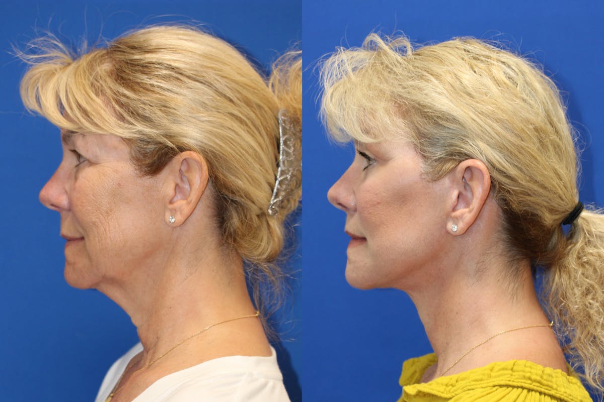 Vertical Restore® / Facial Rejuvenation Before & After Gallery - Patient 153265711 - Image 5