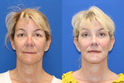 Vertical Restore® / Facial Rejuvenation Before & After Gallery - Patient 153265711 - Image 1