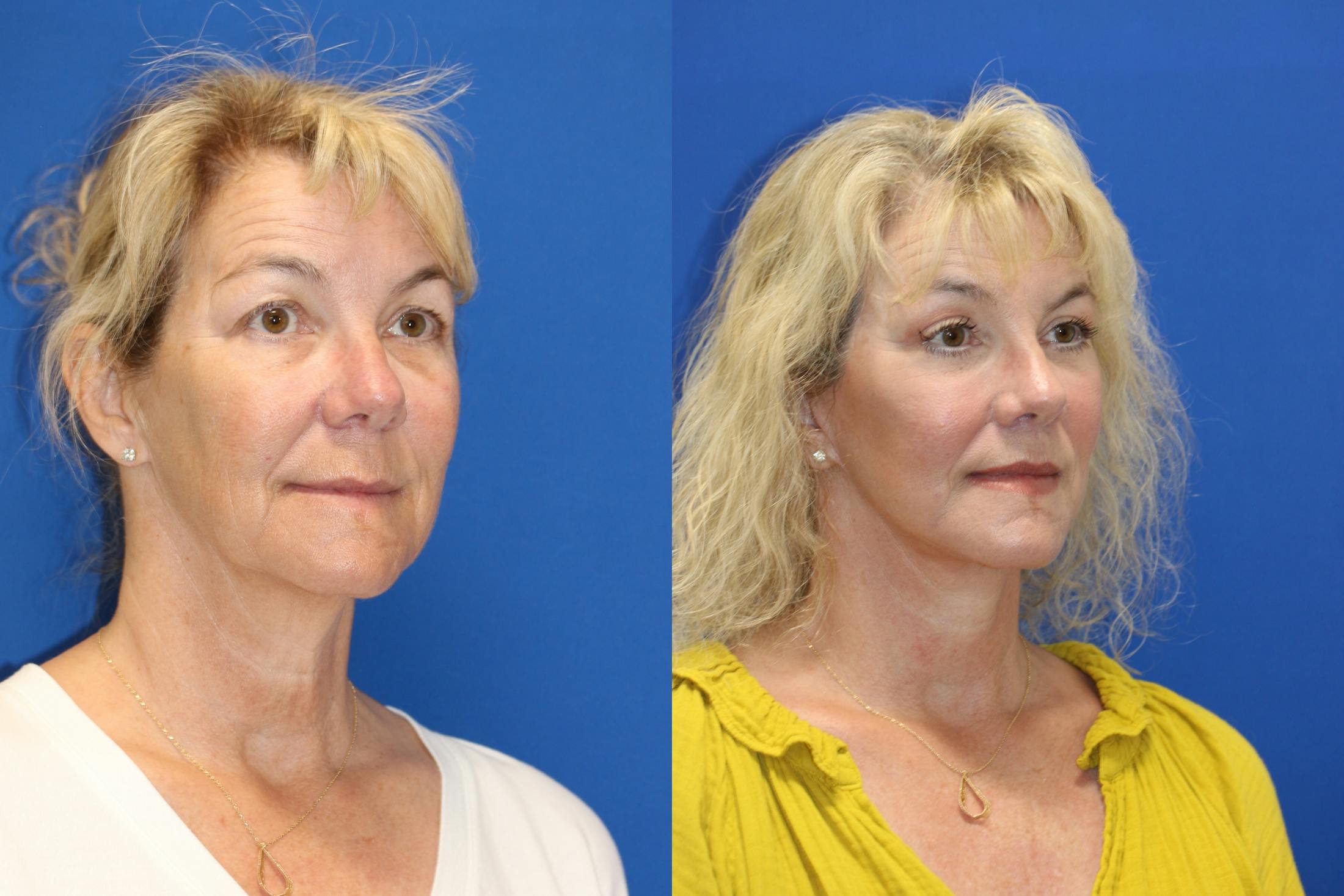 Vertical Restore® / Facial Rejuvenation Before & After Gallery - Patient 153265711 - Image 6