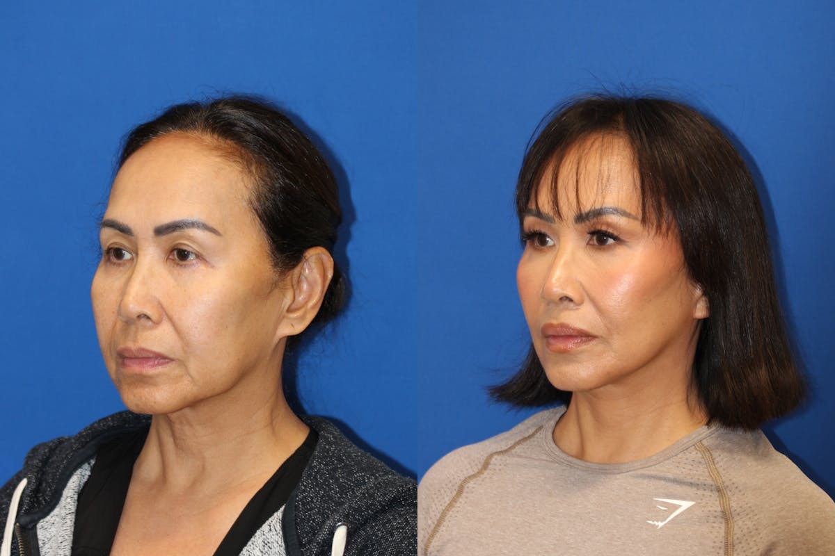 Vertical Restore® / Facial Rejuvenation Before & After Gallery - Patient 153265713 - Image 3