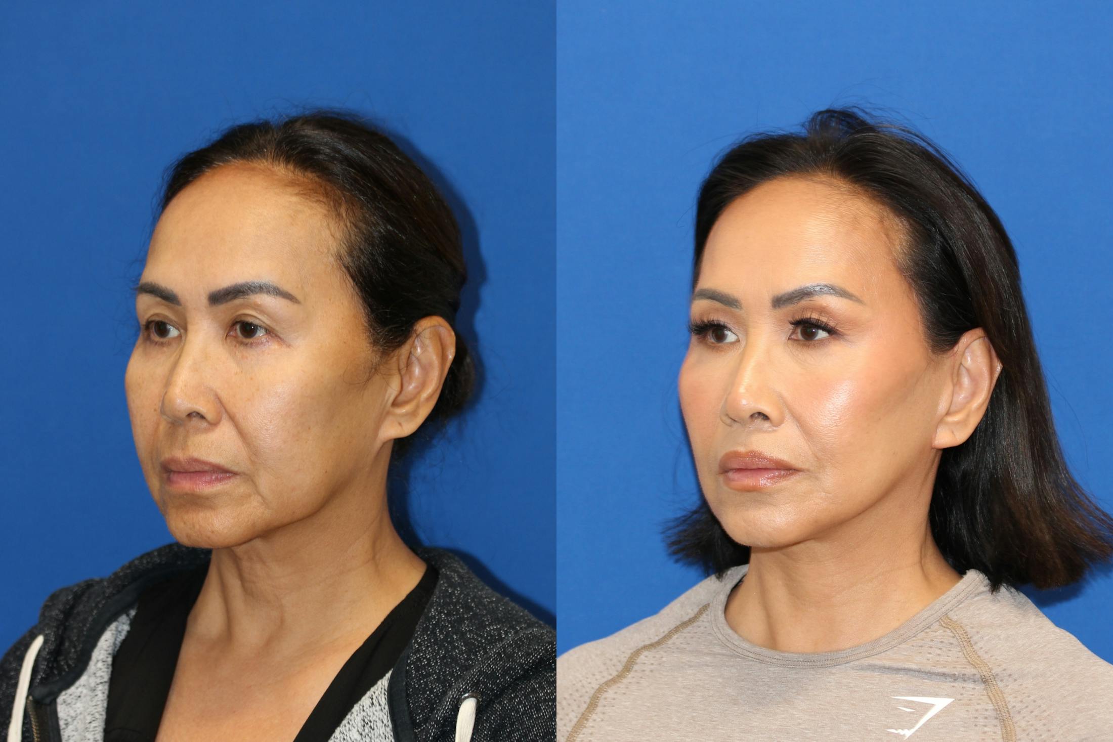Vertical Restore® / Facial Rejuvenation Before & After Gallery - Patient 153265713 - Image 4