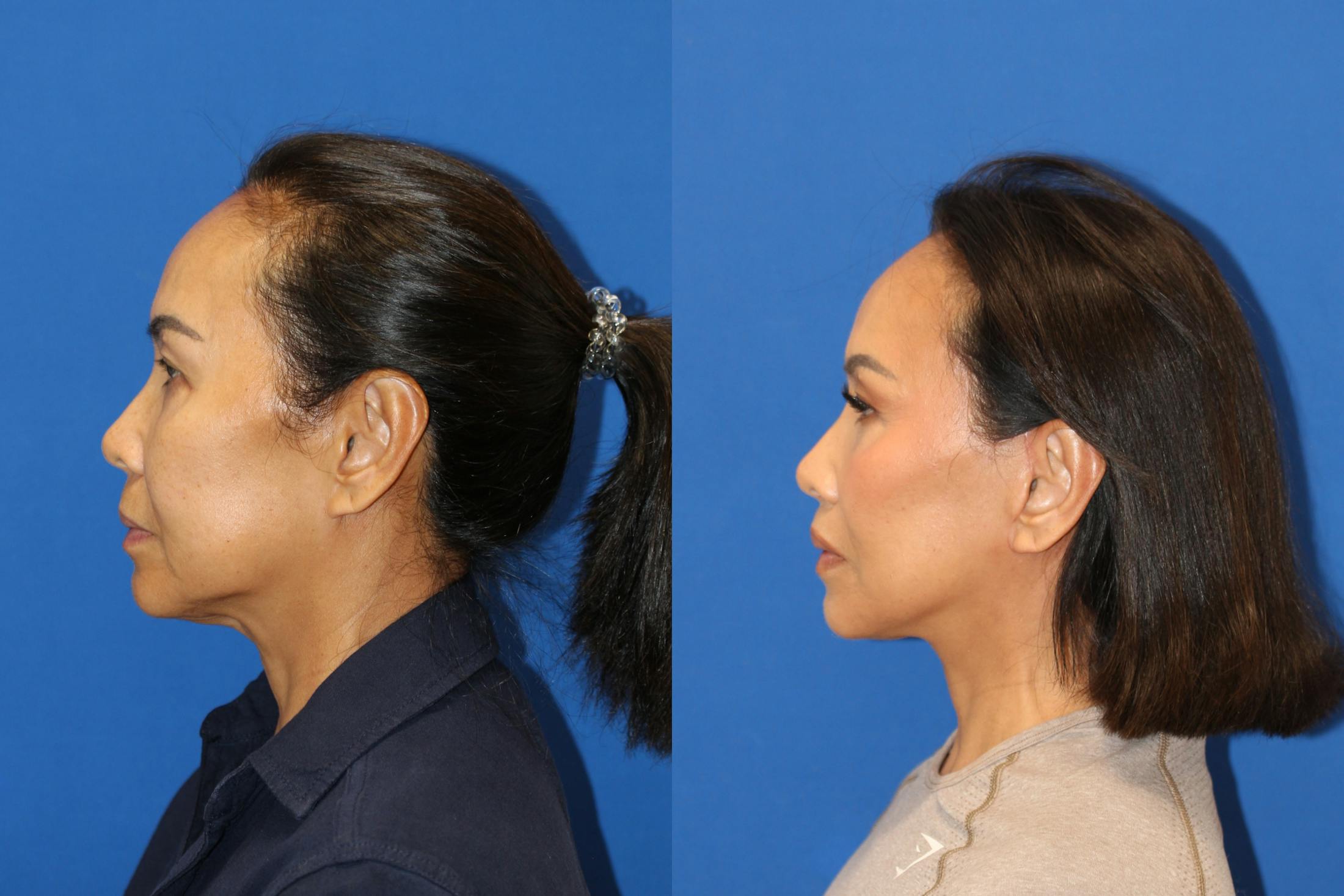 Vertical Restore® / Facial Rejuvenation Before & After Gallery - Patient 153265713 - Image 5