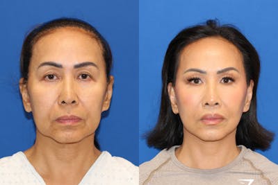Vertical Restore® / Facial Rejuvenation Before & After Gallery - Patient 153265713 - Image 1