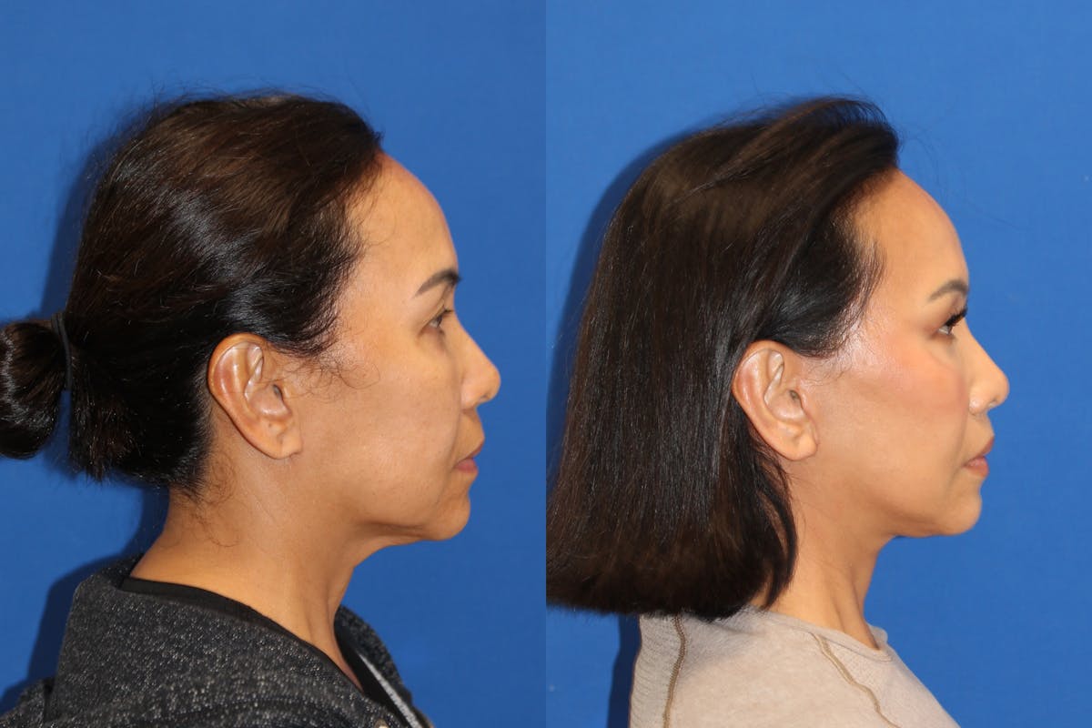 Vertical Restore® / Facial Rejuvenation Before & After Gallery - Patient 153265713 - Image 6
