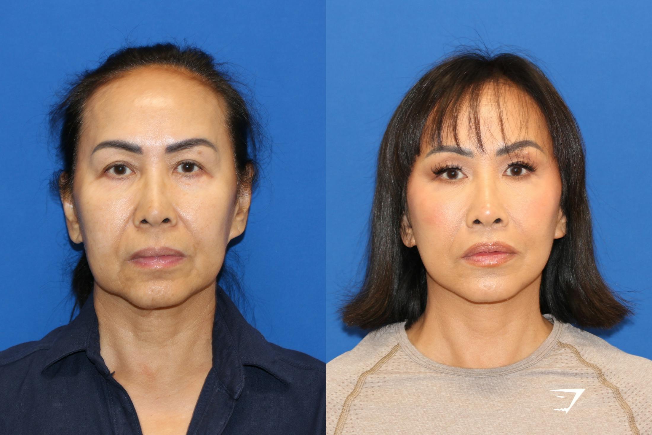 Vertical Restore® / Facial Rejuvenation Before & After Gallery - Patient 153265713 - Image 2
