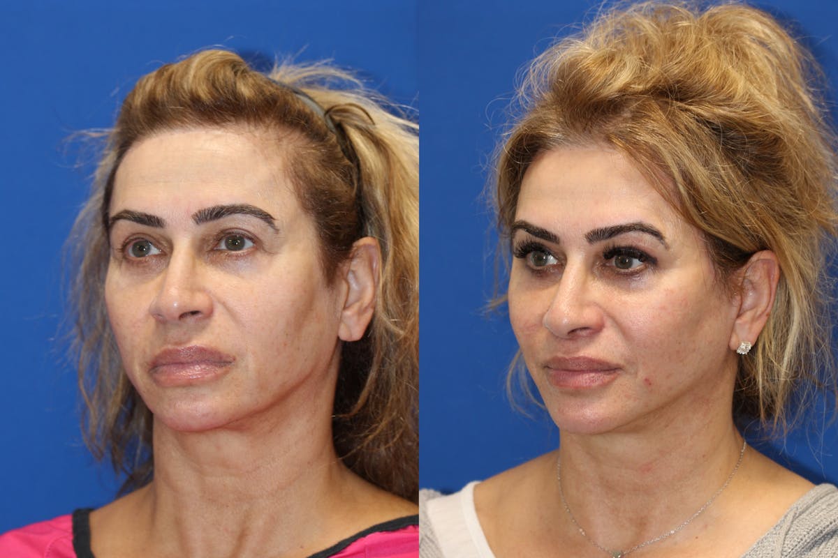 Vertical Restore® / Facial Rejuvenation Before & After Gallery - Patient 153265720 - Image 2