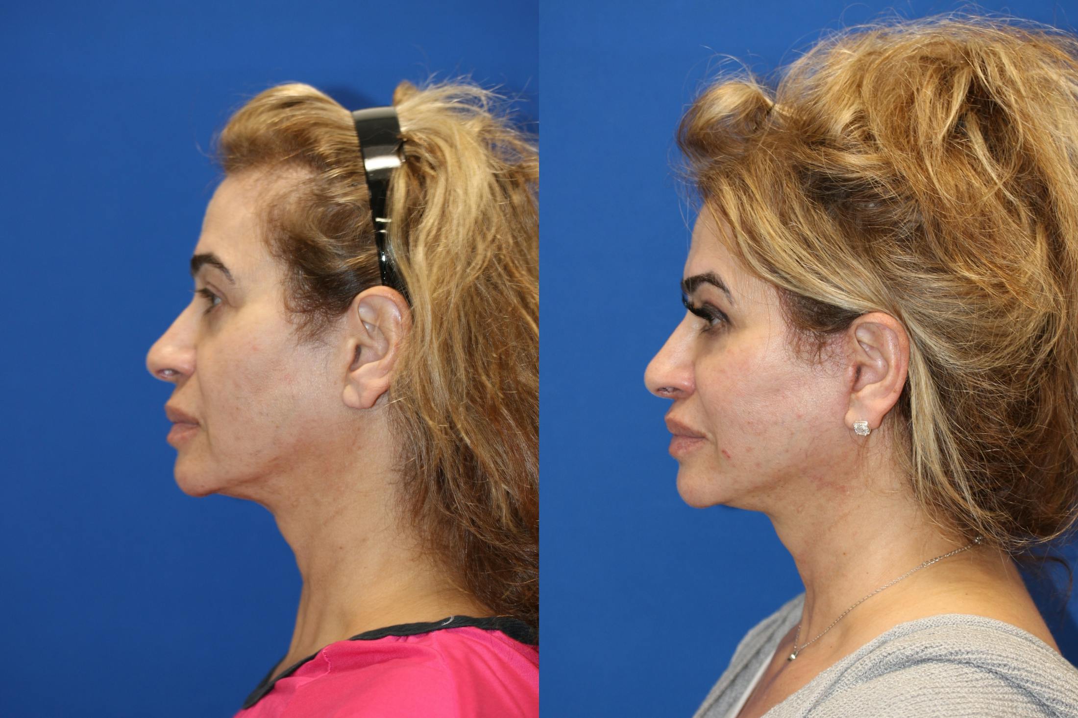Vertical Restore® / Facial Rejuvenation Before & After Gallery - Patient 153265720 - Image 3