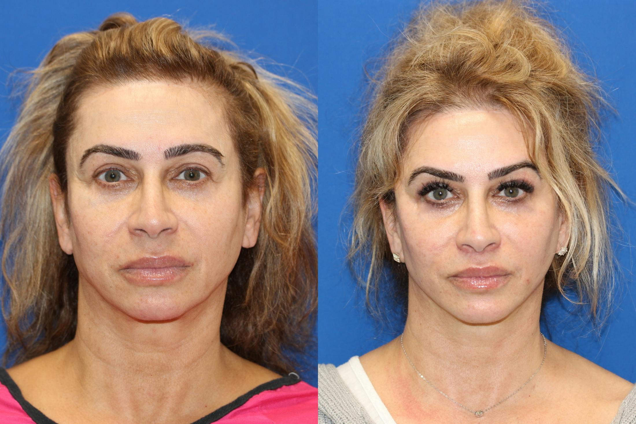 Vertical Restore® / Facial Rejuvenation Before & After Gallery - Patient 153265720 - Image 1