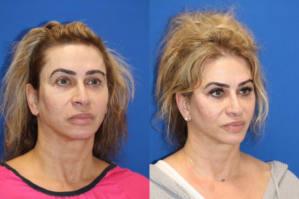 Vertical Restore® / Facial Rejuvenation Before & After Gallery - Patient 153265720 - Image 4