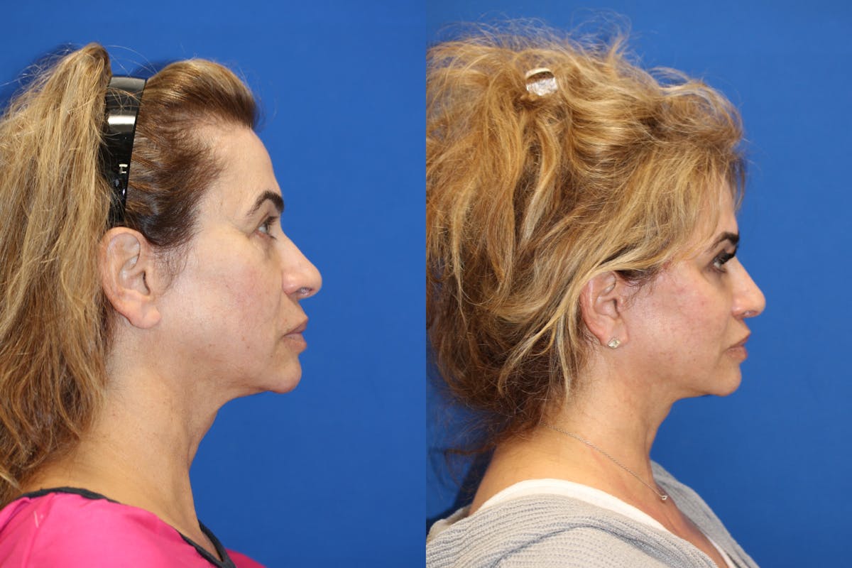 Vertical Restore® / Facial Rejuvenation Before & After Gallery - Patient 153265720 - Image 5