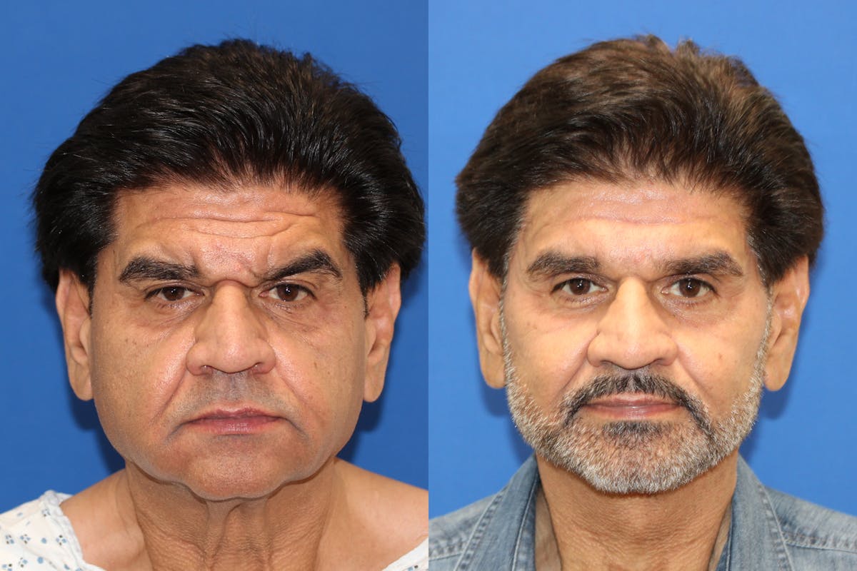 Vertical Restore® / Facial Rejuvenation Before & After Gallery - Patient 153265722 - Image 1