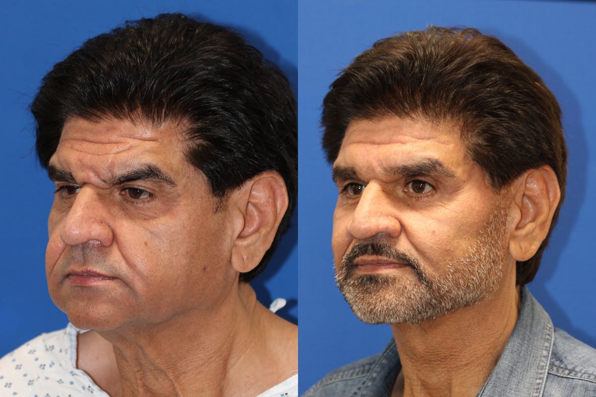 Vertical Restore® / Facial Rejuvenation Before & After Gallery - Patient 153265722 - Image 2