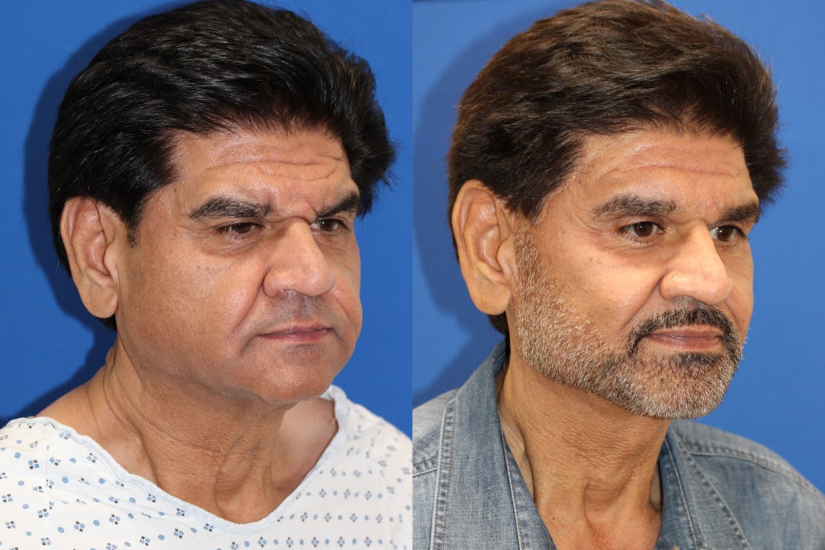 Vertical Restore® / Facial Rejuvenation Before & After Gallery - Patient 153265722 - Image 3