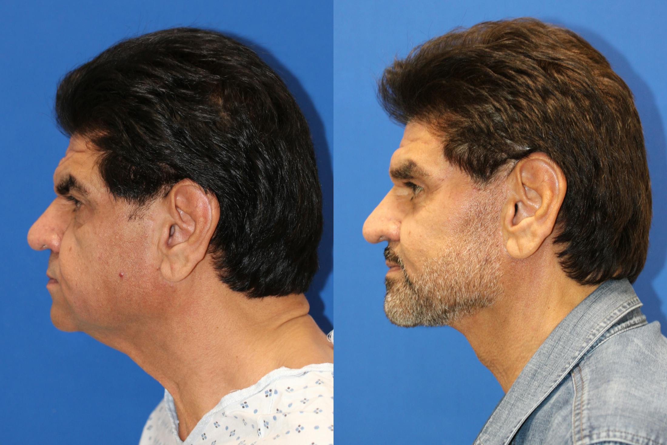 Vertical Restore® / Facial Rejuvenation Before & After Gallery - Patient 153265722 - Image 4