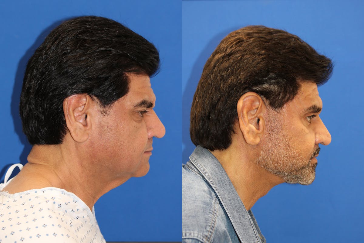 Vertical Restore® / Facial Rejuvenation Before & After Gallery - Patient 153265722 - Image 5