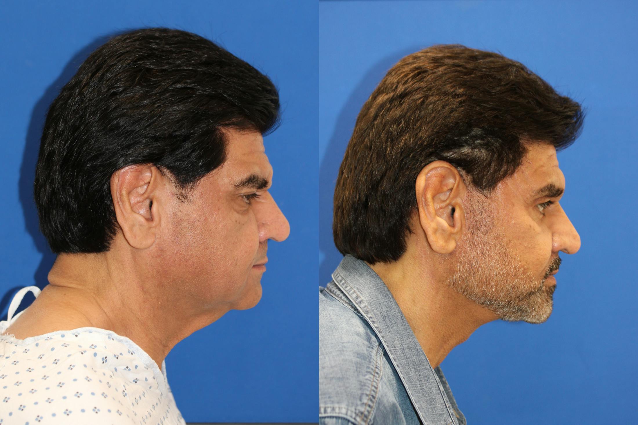 Vertical Restore® / Facial Rejuvenation Before & After Gallery - Patient 153265722 - Image 5