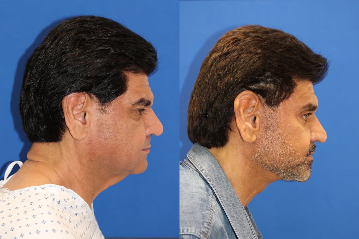 Vertical Restore® / Facial Rejuvenation Before & After Gallery - Patient 153265722 - Image 5