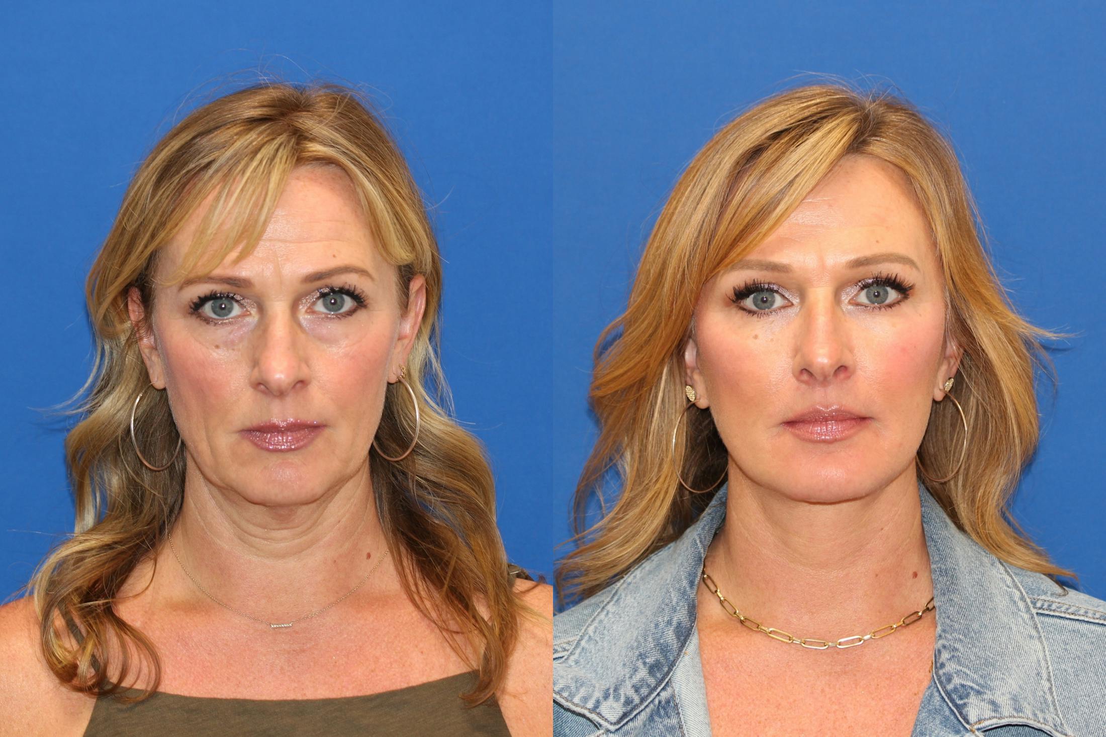Vertical Restore® / Facial Rejuvenation Before & After Gallery - Patient 153265725 - Image 1
