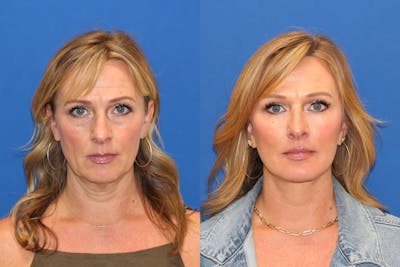 Vertical Restore® / Facial Rejuvenation Before & After Gallery - Patient 153265725 - Image 1