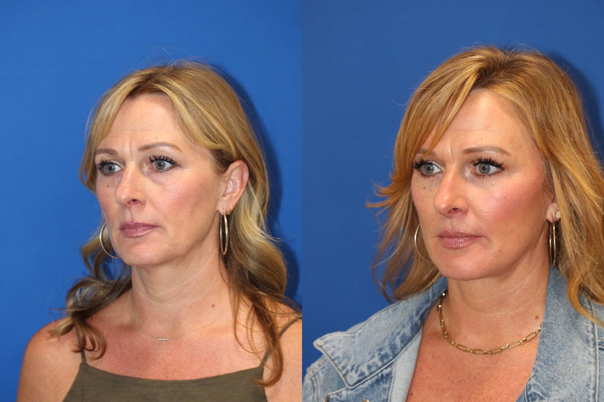 Vertical Restore® / Facial Rejuvenation Before & After Gallery - Patient 153265725 - Image 2